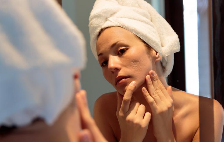main of Getting Treatment for Acne Scars Can Increase Confidence